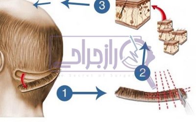 انواع روش کاشت مو