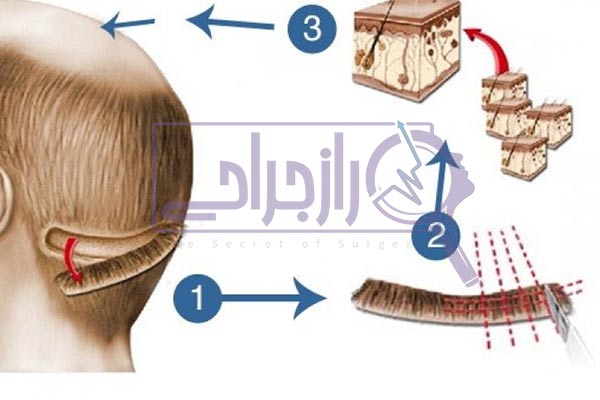 انواع روش کاشت مو - راز جراحی