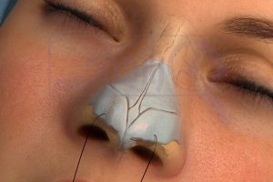 جراحی بینی - راز جراحی