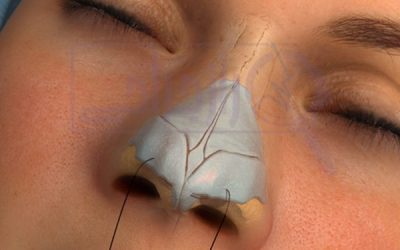 جراحی بینی ۱۰۰% تضمینی 👃 در راز جراحی