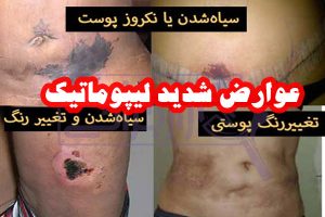 عوارض لیپوماتیک