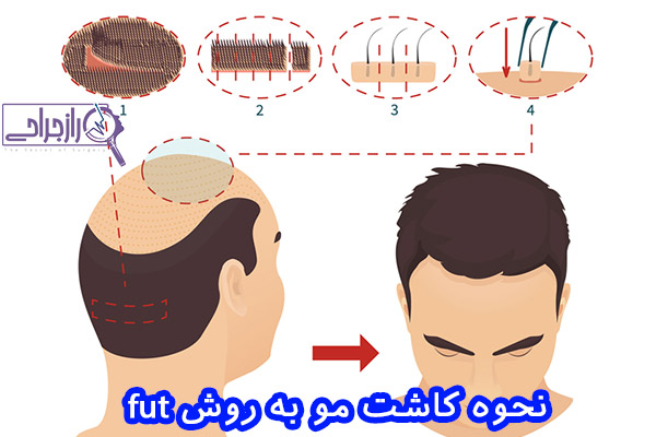 نحوه کاشت مو به روش fut - راز جراحی