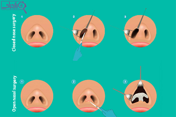 انواع روش جراحی بینی - راز جراحی