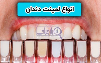 انواع لمینت دندان