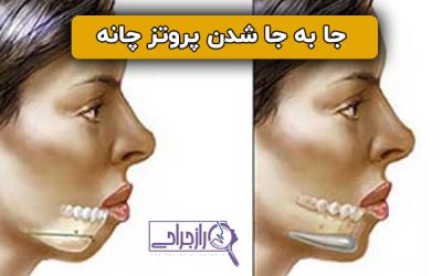 جا به جا شدن پروتز چانه