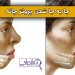 جا به جا شدن پروتز چانه