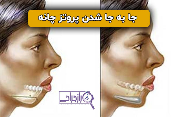 جا به جا شدن پروتز چانه