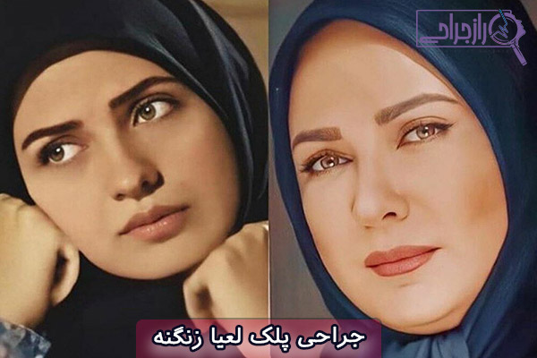 جراحی پلک لعیا زنگنه - راز جراحی