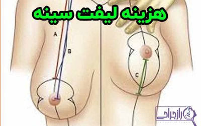 هزینه لیفت سینه