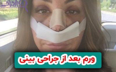 ورم بعد از جراحی بینی