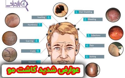 عوارض کاشت مو