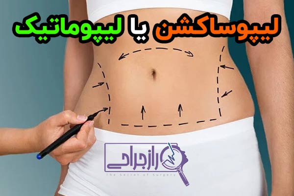 لیپوساکشن راز جراحی