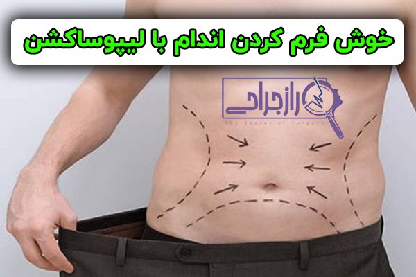 لیپوساکشن