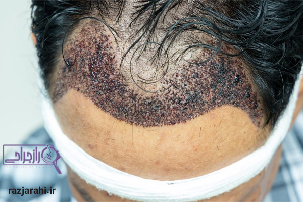 کاشت مو طبیعی - راز جراحی