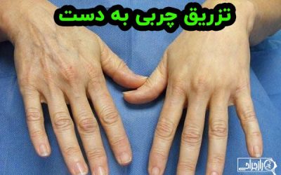 تزریق چربی به دست