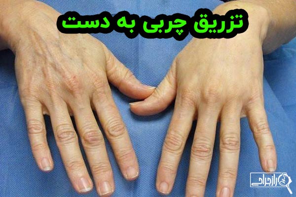 تزریق چربی به دست