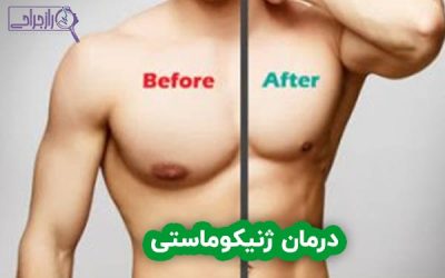 درمان ژنیکوماستی