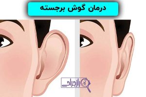 درمان گوش برجسته در راز جراحی