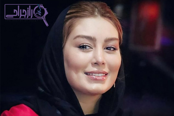 لمینت دندان سحر قریشی - راز جراحی