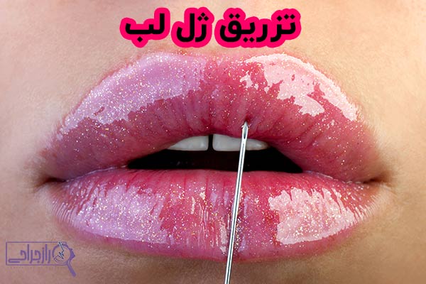 تزریق ژل لب