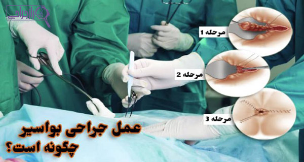 درمان بواسیر با جراحی - راز جراحی