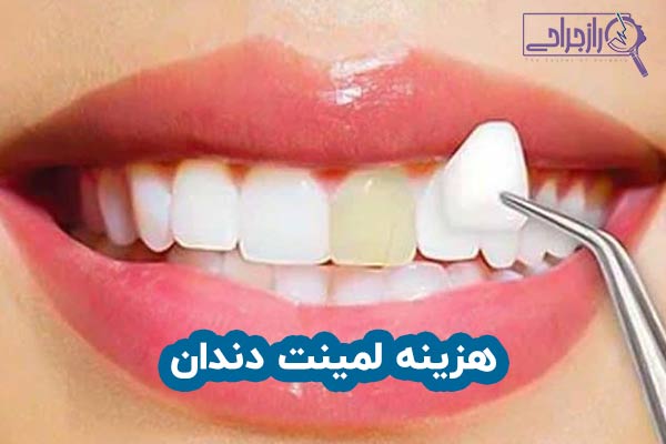 هزینه لمینت دندان