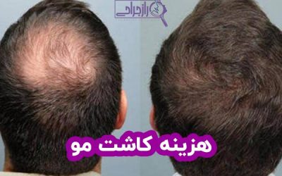 هزینه کاشت مو در سال ۱۴۰۱ + اقساطی