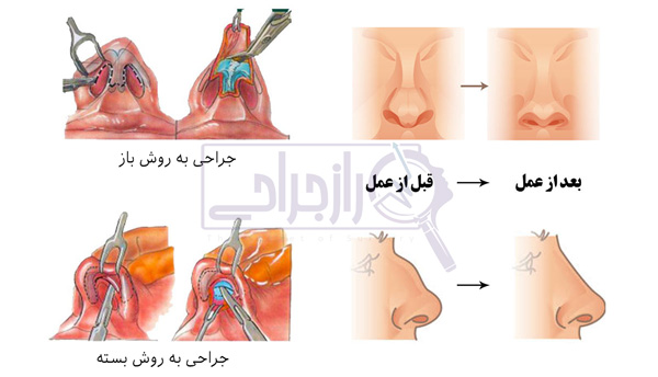 انواع روش جراحی بینی استخوانی - راز جراحی