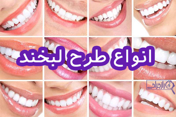 انواع طرح لبخند - راز جراحی