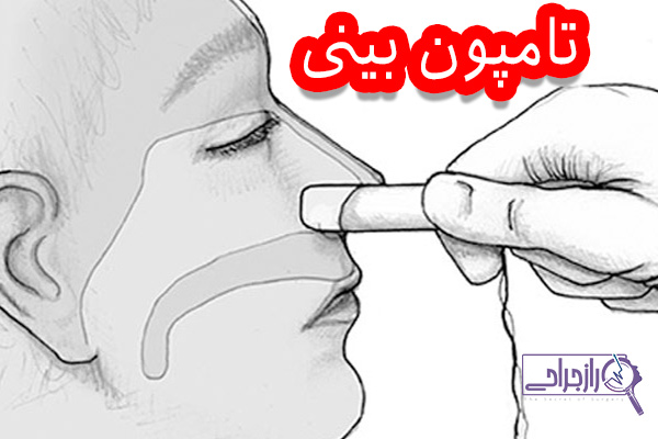 تامپون بینی - راز جراحی