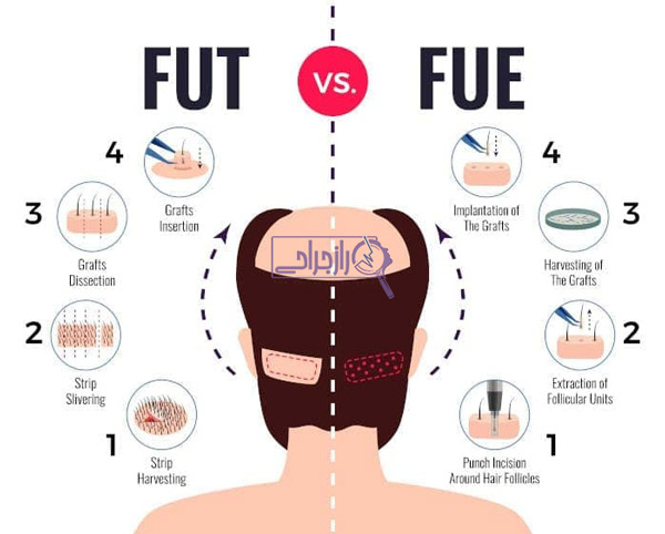 تفاوت کاشت به روش FUT و FUE - راز جراحی