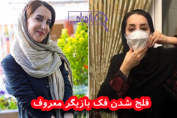 فلج شدن فک بازیگر معروف - راز جراحی