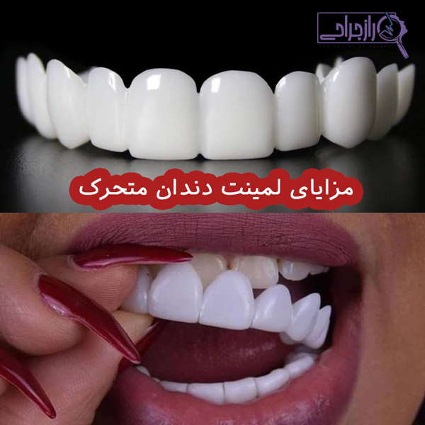 مزایای لمینت دندان متحرک - راز جراحی