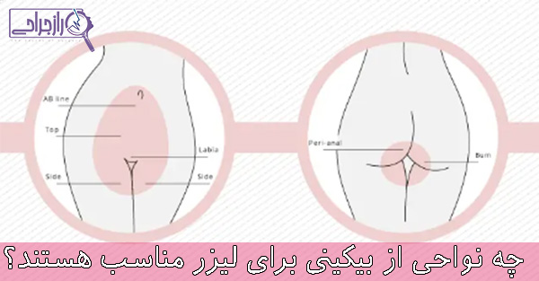 چه نواحی از بیکینی برای لیزر مناسب هستند - راز جراحی