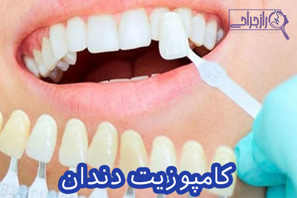 کامپوزیت دندان - راز جراحی