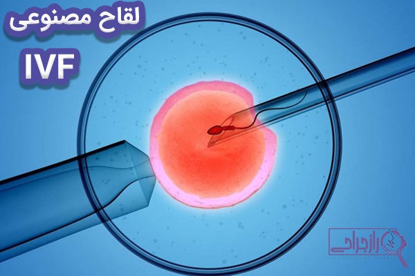 IVF - راز جراحی