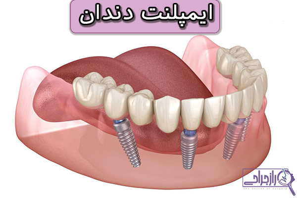 ایمپلنت دندان - راز جراحی