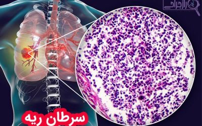سرطان ریه