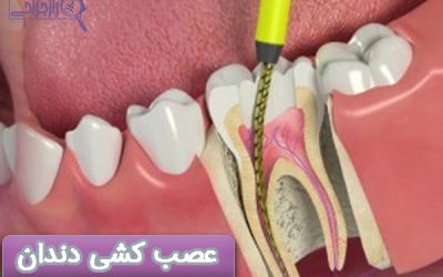 عصب کشی دندان