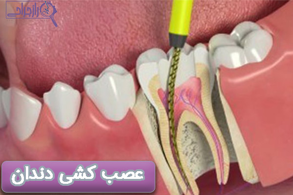 عصب کشی دندان - راز جراحی