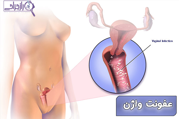 عفونت واژن - راز جراحی