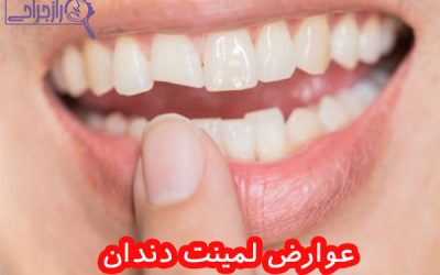 عوارض لمینت دندان