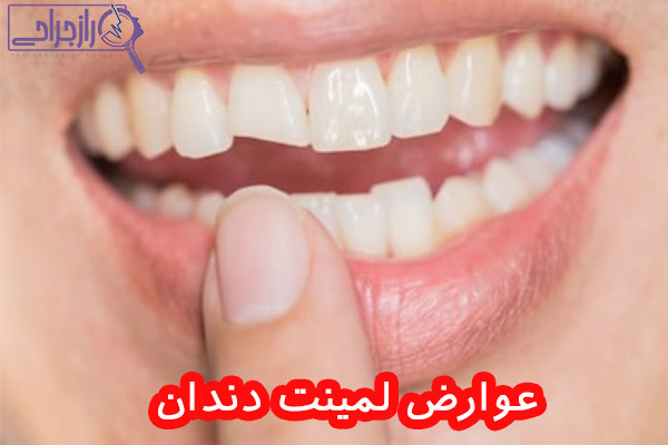 عوارض لمینت دندان - راز جراحی