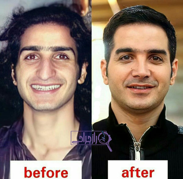 عکس قبل و بعد از جراحی بینی محسن یگانه - راز جراحی