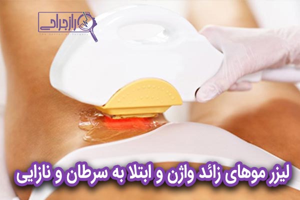لیزر موهای زائد واژن و ابتلا به سرطان و نازایی - راز جراحی