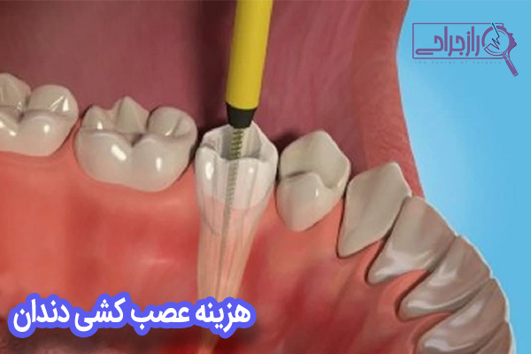 قیمت عصب کشی دندان