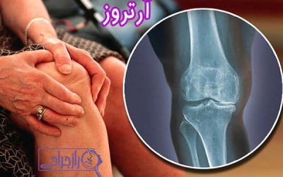 آرتروز