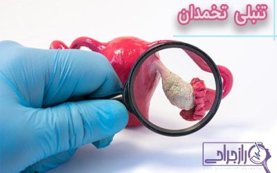 تنبلی تخمدان