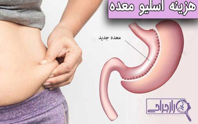 هزینه اسلیو معده