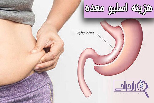 هزینه اسلیو معده